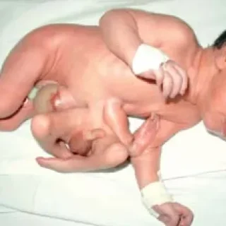 기생쌍둥이 유형 : 일란성 쌍둥이 하지만... 1