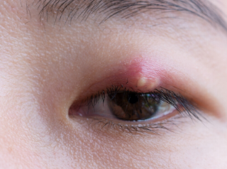 눈꺼풀 다래끼 증상 : 눈꺼풀에 새기는 작고 붉은 융기 47