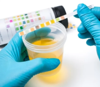 코티솔 검사 : 소변으로 하는 검사 7