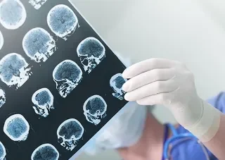 복합 부분 발작 : 국소 의식장애 발작 5