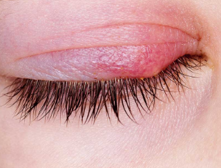 눈꺼풀 염증 원인과 증상 : 안검염, Blepharitis 72