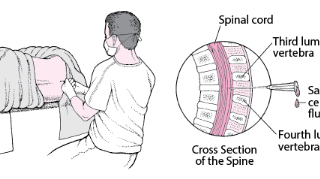 요추천자 : 뇌척수액 검사