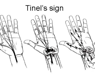 티넬 징후 : 수근관증후군