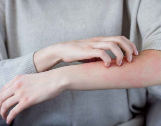 니켈 알레르기 접속성 피부염과 아토피 피부염의 차이 1