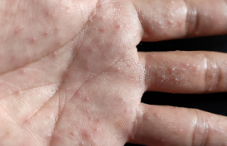 손바닥 발진 원인 8가지: 가렵고 물집이 생겨요~! 1