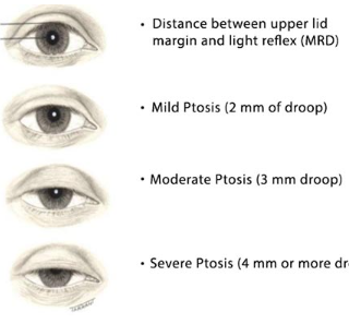 눈꺼풀 처짐 원인 : 안검하수 및 눈꺼풀 목발 9