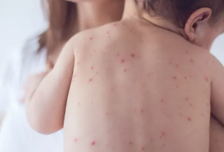 아기 열꽃 두드러기 원인과 증상 65