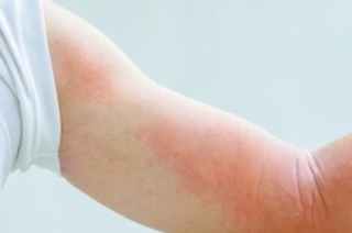 두드러기와 발진의 차이점 구별하는 방법 7