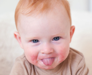 전염성홍반 원인과 증상 : 팔, 다리, 뺨에 붉은 발진 1