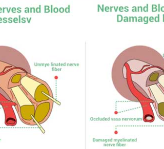 당뇨병성 신경병증 치료제는 어떤 것들이 1
