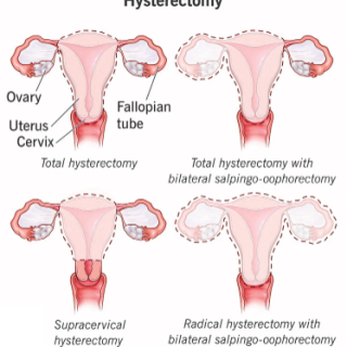 자궁적출술 유형 : 자궁절제술 꼭 해야하나요? 6