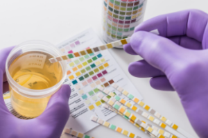 소변 단백 검사 : 소변에 남아 있는 단백질의 양 측정