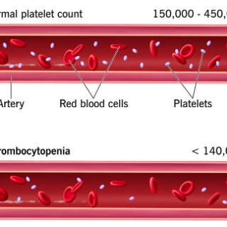 혈소판 감소증 : 쉽게 멍이 들거나 장기간 출혈