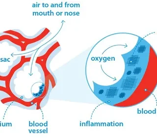폐섬유증, 폐 흉터와 상흔으로 호흡부전,심부전 초래