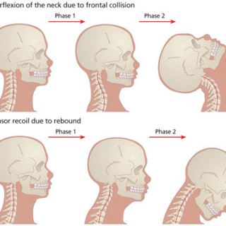 경추편타증, Whiplash-injury