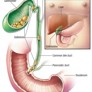 담석 발생 위치