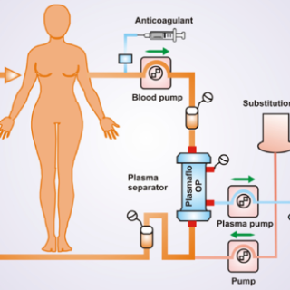 혈장분리교환술 과정