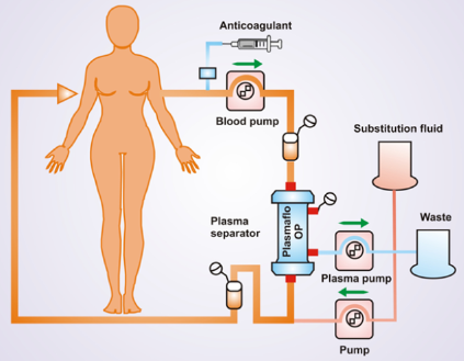 혈장분리교환술
