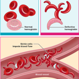 낫적혈구빈혈증, 겸상적혈구빈혈증