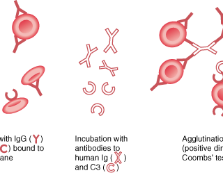 쿰즈 검사 : 직접 항글로블린 검사