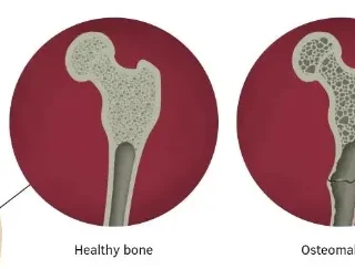 골연화증으로 뼈가 약해짐