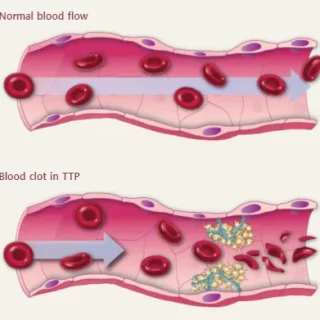 혈전성 혈소판감소성 자반병 : 혈소판