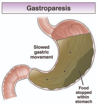 위마비와 배출 지연