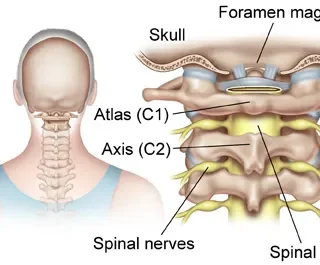 C2 척수 손상, spinal cord injury, SCI 91