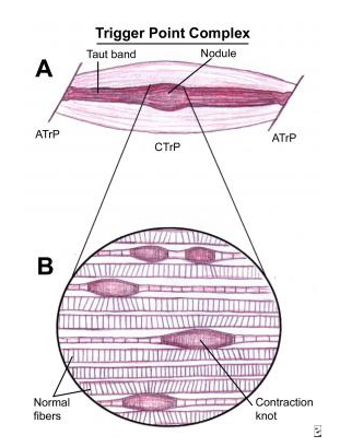 trigger point and taut band